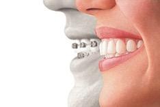 Teeth-invisalign